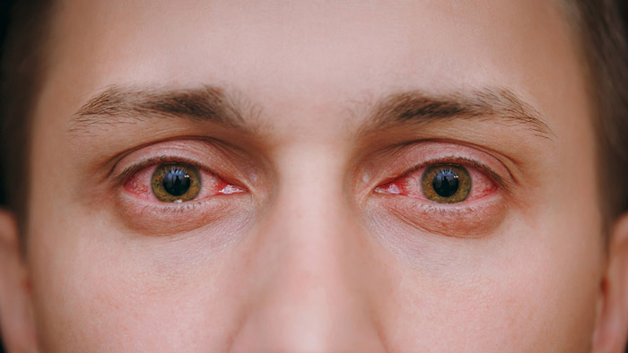 red-eye-hero-700x394.jpg