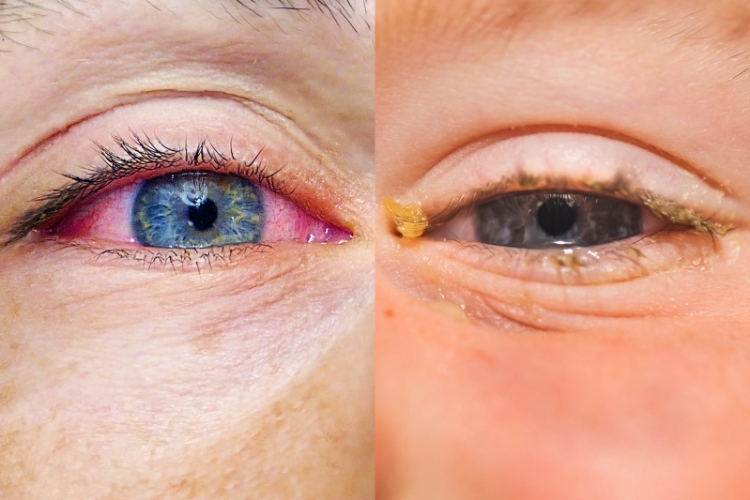 allergies-or-pink-eye-here-s-how-to-tell-the-difference__609847_.jpg